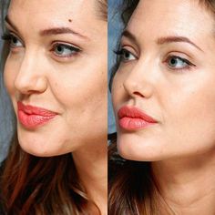 a woman's face before and after using lip fillers