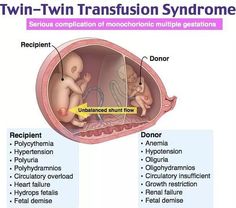 the diagram shows how twin - twin transstition syndrome are related to each other