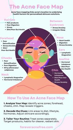 Unlock clearer skin with our guide to the acne face map. Discover personalized solutions for healthier skin. Face Map Acne, Acne Face Mapping, Acne Chart, Acne Face Map, Face Map, Face Mapping Acne, Face Mapping, Acne Face