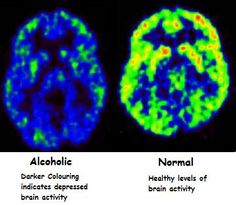 two brain images showing normal and abnormal activity