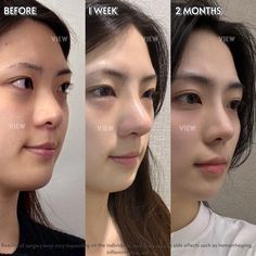 View Plastic Surgery in Korea For more information: ❤️Eng Whatsapp: +82 010 7112 7174 ❤️Rus Whatsapp: +82-10-5370-7174 Copyrights to images and all other materials related to this content belong to View Plastic Surgery and you may be liable for unauthorized distribution and/or reproduction of the same without written consent.   #rhinoplasty #plasticsurgery #korea #nose #facialcontouring #viewplasticsurgery Plastic Surgery Korea, Facial Contouring, Quick Outfits, Official Account, Skin Problems, Visual Design, Plastic Surgery, Fashion Makeup, Surgery