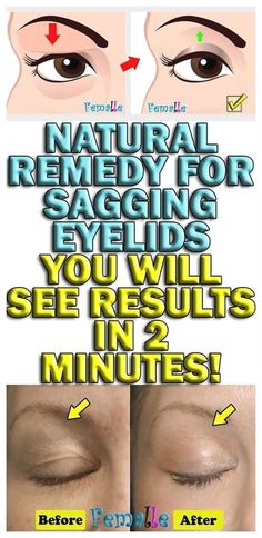 Sagging Eyelids, Natural Healing Remedies, Diy Remedies, Beauty Remedies, Natural Therapy, Natural Diy, Natural Remedy, Natural Home Remedies, Belleza Natural