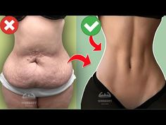 a woman's stomach before and after tummypomus surgery with an arrow pointing to the side