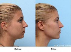 Nose Surgery Rhinoplasty, Chin Filler, Plastic Surgery Photos, Angular Face, Botox Cosmetic, Cheek Fillers