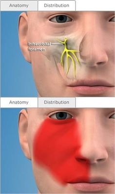 infra orbital nerve block...When would you use an infra orbital nerve block? Dentaltown has online courses on anesthesia. Local Anesthesia in Dentistry and Considerations for Mandibular Anesthetic Success" by Jason H. Goodchild, DMD. http://www.dentaltown.com/Dentaltown/OnlineCE.aspx?action=DETAILS&cid=323 Take Control of Your Schedule with Precision Buffering of Local Anestheticsby Mark Hyman DDS and Mic Falkel DDS. http://www.dentaltown.com/Dentaltown/OnlineCE.aspx?action=DET Local Anesthesia, Dentist Assistant, Registered Dental Hygienist, Dental Images, Medical Mnemonics, Dental Hygiene School, Dentistry Student, Dental Anatomy, Aesthetic Dentistry