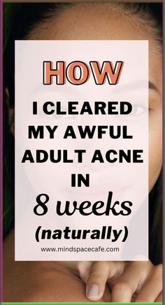 acne prone skin care, acne skincare routine simple, how to get rid of adult acne, how to get rid of acne naturally, acne and pimples home remedies, home remedies for acne, how to get clear skin, cystic acne treatment, how to get rid of acne as an adult, how to remove cystic acne, how to get rid of acne marks, how to get rid of acne naturally, how to clear skin, acne glow up, acne night routine What Helps Clear Up Acne, Gut Health For Acne, How To Reduce Acne And Pimples, How To Remove Acne Marks At Home, How To Clear Up Your Skin In A Week, How To Clear Hormonal Acne, Types Of Acne And How To Treat, How To Clear Up Acne, Neck Acne Causes