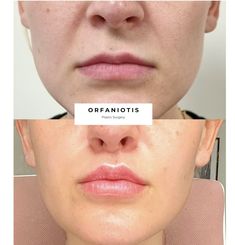 Lip Lift Before and After Gallery Lip Lift, Botox Before And After, Lip Augmentation, Lip Enhancement, Cosmetic Procedures, Upper Lip, Lip Fillers