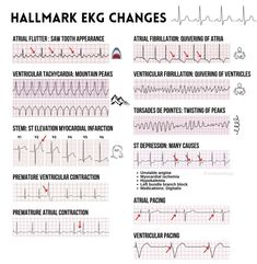 Ekg Notes, Ekg Interpretation Made Easy, Coronary Angiography, Medical Room, Emt Study, Er Tech, Cardiac Sonography, Ecg Interpretation