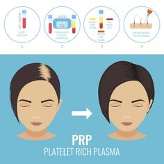 Prp Hair, Blood Plasma, Hair Transplant Surgery, Platelet Rich Plasma, Best Hair Transplant, Hair Breakage, Hair Restoration, Hair Transplant, Cosmetic Surgery