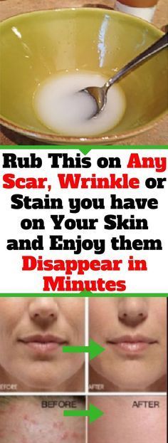 Rub This on Any Scar, Wrinkle or Stain you have on Your Skin and Enjoy them Disappear in Minutes Essential Oil Skin Care, Eliminate Wrinkles, Essential Oils For Skin, Cooking For Beginners, Oil Skin Care, Prevent Wrinkles, Essential Oil Uses, Natural Medicine, Oils For Skin