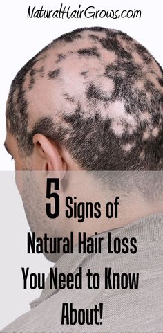 Natural Hair Loss: 5 Signs You Need to Pay Attention To! Scarring Alopecia, Weave Installation, Clean Scalp, Tight Braids, Natural Hair Diy, Bald Patches