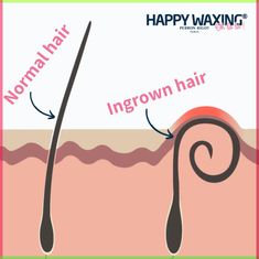 Get rid of ingrown facial hair with our expert tips. Learn about causes, prevention, and effective treatments for a smooth, irritation-free beard. Ingrown Hairs, Normal Hair, Ingrown Hair, Facial Hair, Hair Removal, Bump, Beauty Tips, Shaving