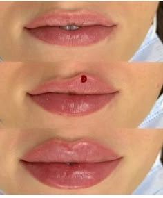 Lip Injections Heart Shape, Lip Filler Inspiration Heart Shaped, Keyhole Pout Lip Filler, Lip Injections Inspiration, Jolie Lip Filler, 1.5 Ml Lip Filler, 1ml Lip Filler Shapes, Lip Filler Lips, Lip Fillers Before And After 1ml Russian