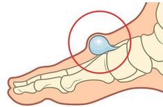 Rheumatoid Nodules, Fig Paste, Types Of Bones, Medical Knowledge, Emergency Kit