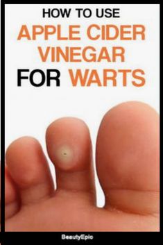 Wart Remedies, Apple Cider Vinegar Warts, Apple Cider Vinegar Bath, Vinegar Bath, Warts Removal, Apple Cider Vinegar Remedies, Vinegar Recipes, Eggs Healthy, Home Remedies For Warts