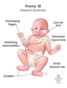 Nicu Nurse Education, Edwards Syndrome, Nursing School Studying Cheat Sheets, Medical Assistant Student, Medical School Life