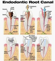 Steps of a root canal- love dentistry! Kedokteran Gigi