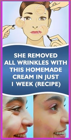 SHE REMOVED ALL WRINKLES WITH THIS HOMEMADE CREAM IN JUST 1 WEEK Get Rid Of Warts, Weight Changes, Cosmetics Industry, Natural Cough Remedies, Anti Aging Treatments, Lose 40 Pounds, Natural Home Remedies