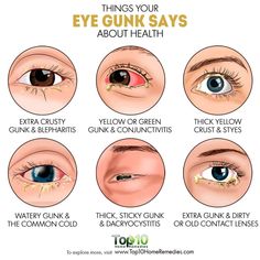 Eye Health Facts, Eye Health Remedies, Remedy For Sinus Congestion, Pinkeye Remedies, Home Remedies For Sinus, Eye Twitching, Healthy Book, Top 10 Home Remedies