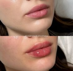 We’re beyond excited to showcase the amazing results of a recent lip filler treatment for our lovely client.  ✅ Plump, voluminous lips that look effortlessly natural ✅ Beautifully contoured shape for that perfect pout ✅ Enhanced facial harmony and a boost in confidence!  📍1934A Williamsbridge Rd, Bronx, NY   📲 (917) 701-0253  📞 (585)441-3838 #lipfillernewyork #lipfillersnewyork #lipfillernyc #lipinjectionsnyc #lipinjectionsnewyork #lipfillerbronx #lipfillersbronx #lipsinjectionnyc Ariana Grande Lip Fillers, Julie Horne Lip Filler, Flat Lips Filler, Lips Fillers Shapes, Lip Flip Vs Filler, Natural Lip Fillers 0.5ml, Natural Looking Lip Fillers, Pouty Lip Filler, Lip Filler Natural