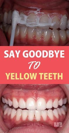 Teeth Yellow, Healthy Teeth And Gums, Brushing Your Teeth, Whiter Teeth, Yellow Teeth