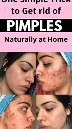 get the best remedies for removing pimples Pimples Remove Tips For Girl, How To Remove Pimples, How To Get Rid Of Pimples, Skin Concern, Stand Tall, Natural Remedies