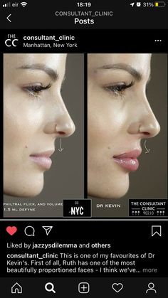 Small Mouth With Lip Injections, Nose Injections Before And After, Kendall Jenner Lip Fillers, Natural Fillers For Face, Lip Filler Side Profile, Lip Filler Inspo Natural, Lips Surgery, Natural Lip Fillers