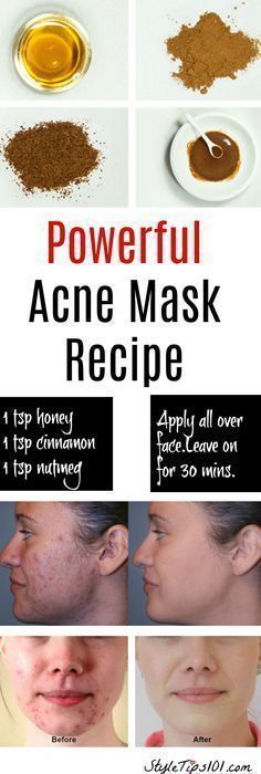 Overnight Face Mask For Acne, Best Home Remedy For Acne, Home Remedy For Acne, Natural Acne Mask, Diy Overnight Face Mask, Homemade Acne Mask, Remedies For Pimples, Remedy For Acne, Face Mask For Acne