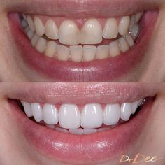 Before and after results of a patient's porcelain veneers done by Dr. Dee. Teeth Makeover, Naturally Whiten Teeth, Cosmetic Dentistry Procedures, Composite Veneers, Facial Contouring, Laser Surgery