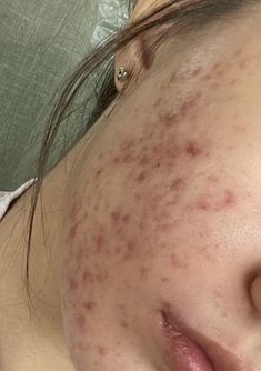 Acne Girls Pretty, Bad Acne Pictures, Acne Wallpaper, Beauty Marks On Face, Acne Pretty