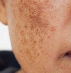 Post Inflammatory Hyperpigmentation, Treating Hyperpigmentation, Dark Spots On Face, Brown Spots Removal, Spots On Face, Tranexamic Acid, Face Acne