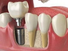 Super Dental Crown Metals #dentistrylove #DentalCrownMouths Dentist Quotes, Teeth Tips, Affordable Dental Implants, Dentist Teeth, Tooth Infection, Dental Implant Procedure, Best Dental Implants