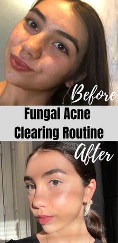 Acne Clearing, Clear Skin Care, Fungal Acne, Forehead Acne, Acne Prone Skin Care, Lotion For Oily Skin, Acne Overnight, Anti Wrinkle Skin Care, Acne Skincare Routine