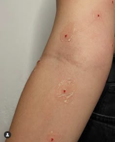 an arm with red spots on it