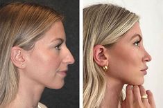 Droopy Tip Nose Rhinoplasty, Prominent Nose Women, Feminine Facial Surgery, Nose Jobs Before And After, Dorsal Hump Nose, Nose Job Front View, Bulbous Nose Rhinoplasty Before After, Big Nose Aesthetic, Nose Job Before And After