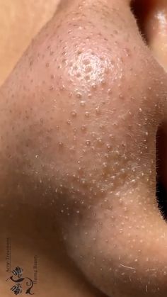 Pure Satisfaction, Blackhead Remover Diy, Blackhead Extraction, Glow Cloud, Blackheads Removal, Clear Skin Tips