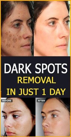 Dark Spots Removal, Spots On Legs