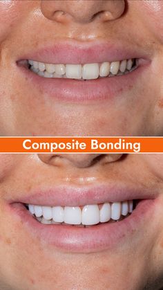 Our patient was self-conscious about her smile and wanted to brighten and level her teeth. As a result, the patient felt hesitant to smile in public. Dr Niall applied the composite resin material to the teeth and shaped them, giving them a highly aesthetic look. The patient was thrilled with the results. The composite bonding restored the appearance of her teeth, giving her a brighter and more attractive smile. She feels more confident in her smile and no longer hesitates to show it off. Uneven Teeth Aesthetic, Nice Teeth Smile Aesthetic, Cosmetic Bonding Teeth, Dental Bridge Front Teeth, Cosmetic Bonding, Teeth Bonding, Dental Cement, Composite Bonding