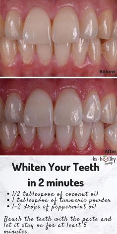 5 consejos para blanquear los dientes de forma natural Remedies For White Teeth, Make Teeth Whiter, Get Whiter Teeth, Teeth Whitening Homemade, Teeth Whitening Remedies, Homemade Deodorant, Teeth Whitening Diy, Whiter Teeth, Whiten Teeth