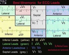 ECG Ecg Interpretation, Critical Care Nursing, Nursing School Notes