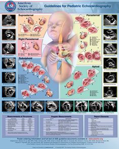 Pediatric Echocardiography, Sonogram Technician, Ultrasound Technician School, Ekg Leads, Cardiac Sonography, Sonography Student, Nursing School Inspiration, Ultrasound Sonography, Pediatric Medicine