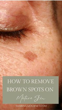 Remove Brown Spots On Skin, Spots On Face How To Get Rid Of, Diy Age Spot Remover The Face, Dark Spot On Face Remedies, Natural Dark Spot Remover, Dark Spot Remover For Face Homemade, Sun Spots Removal Diy, Clearing Dark Spots On Face, Lighten Dark Spots On Face