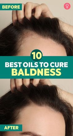 How To Grow Hair Back In Bald Spot, Hair Growth For Bald Spots, How To Grow Hair In Bald Spots, How To Get Rid Of Bald Spots For Women, Expensive Hair, Thinning Hairline, Hair 101, Aging Hair, Receding Hairline