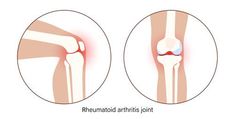 Natural Pain Relief For Joints, Pain Relief