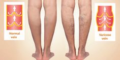 Over 30,000,000 Americans have vein disease. And less than 5% of these people get properly diagnosed. Often vein conditions progress over time. Learn more… Varicose Vein Natural Remedy, Varicose Veins Exercises, Vericose Veins Essential Oil, Vulvar Varicosities Pregnancy, Disease, Conditioner