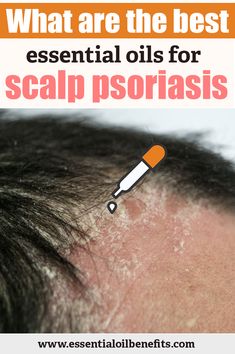 Skin Issues On Scalp, Essential Oils For Scalp, Oils For Scalp, Bath Therapy, Scalp Issues, Essential Oil Benefits, Natural Cough Remedies, Skin Remedies, Best Essential Oils