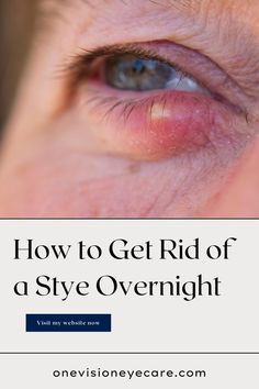 Sty Remedy How To Get Rid, Sty In The Eye Remedies How To Get Rid, How To Get Rid Of A Stye On Your Eyelid, Remedies For Stye On Eyelid, Eyelid Irritation Remedies, Sty Eye Remedies How To Get Rid