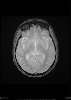 Moyamoya Disease, Caudate Nucleus, Tuberous Sclerosis, Internal Carotid Artery, Basal Ganglia, Arteries And Veins, Homemade Facials, Central Nervous System, Radiology