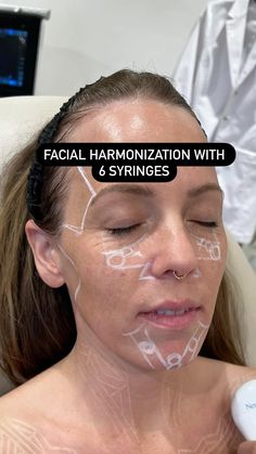 Nicola Lowrey PA-C | Facial Harmonization with 6 syringes. I kinda feel like I can leave this one right here. No caption necessary. Invest less than one… | Instagram Cosmetic Fillers, Assessment Strategies, Thread Lift, Facial Fillers, Diy Beauty Treatments, Facial Plastic Surgery, Facial Aesthetics, Aesthetic Medicine