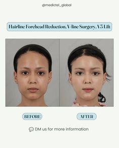 Hairline Forehead Reduction, V-line Surgery, V3 Lift: Here's all you need to know ⬇️ ✅️ Hairline Forehead Reduction: This procedure designs the hairline to bring it forward and decrease the height of the forehead. Transposition ensures a much more balanced proportion with other facial features. ➡️ Benefits: - It enhances facial harmony by creating a more proportionate forehead.  - Reduces the appearance of a high forehead, which is aging. ➡️ Considerations: - As with all surgeries, swel... Reduce Forehead Size, Fine Lines On Forehead, Forehead Surgery, Forehead Lowering Surgery, Dysport Before And After Forehead, Facial Harmony, Forehead Reduction Surgery, Forehead Reduction, Facial Aesthetic